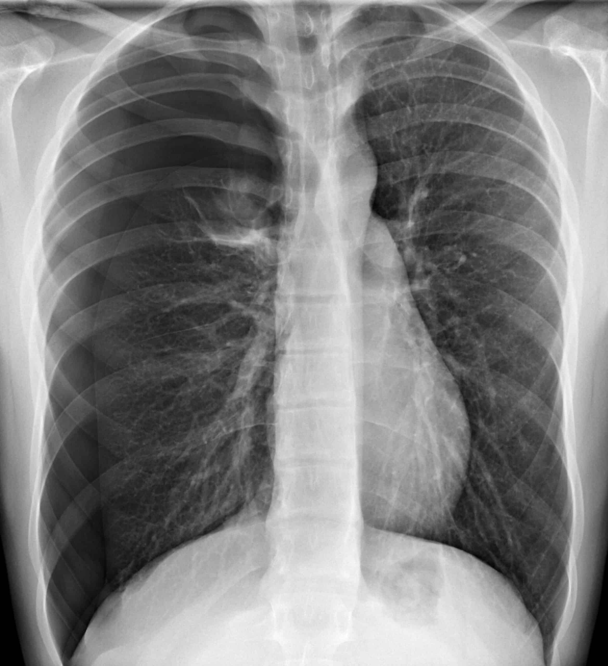 Tension pneumothorax x-ray.