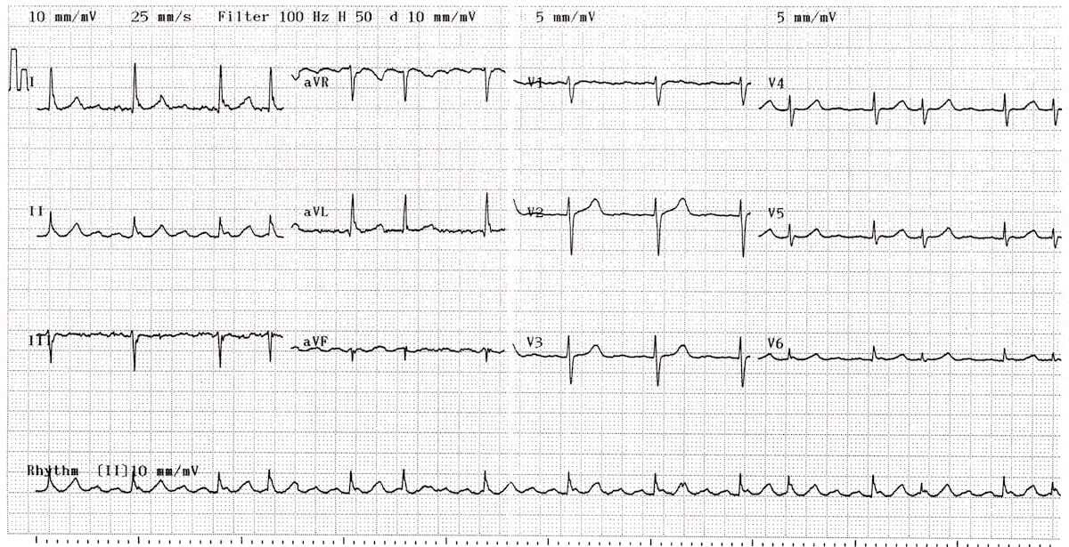 Uncommon atrial flutter ECG.