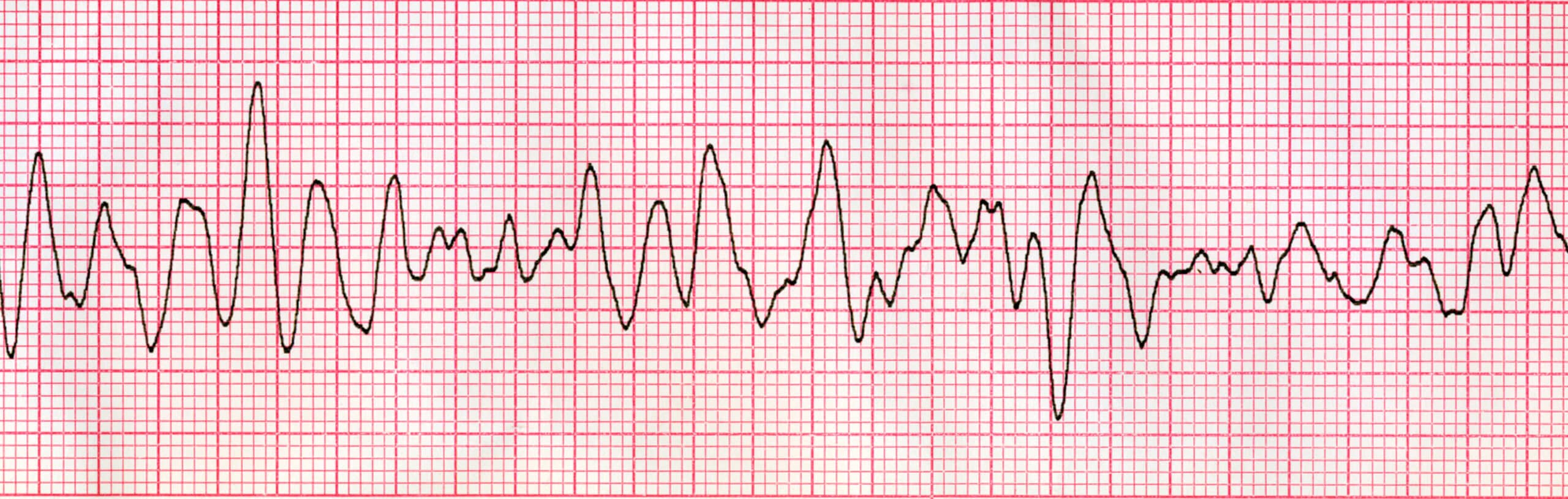 Ventricular fibrillation is shockable rhythm.