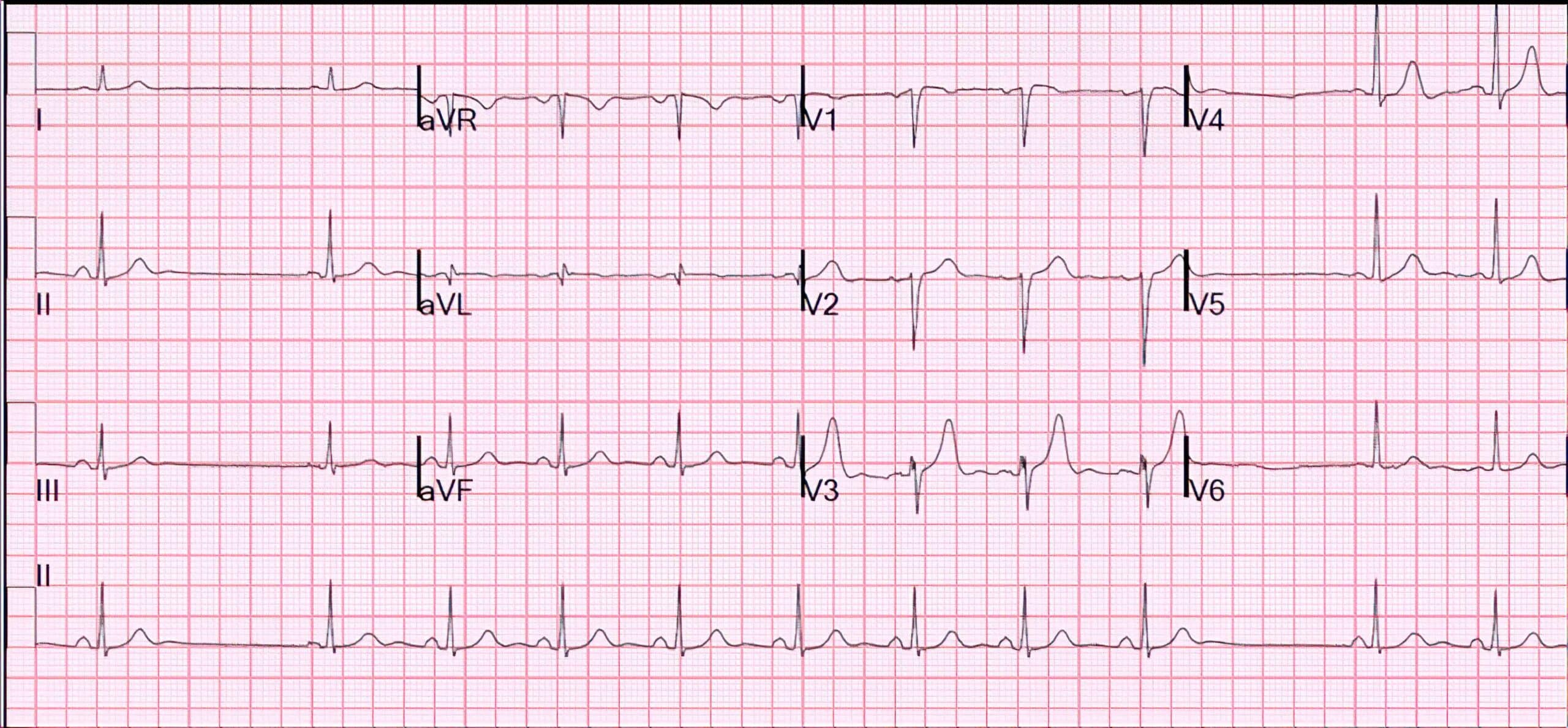 Young patient with palpitations ECG.