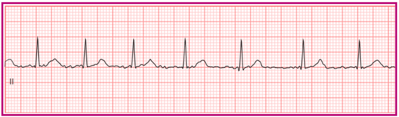 Atrial fibrillation ECG with irregular, wandering baseline.