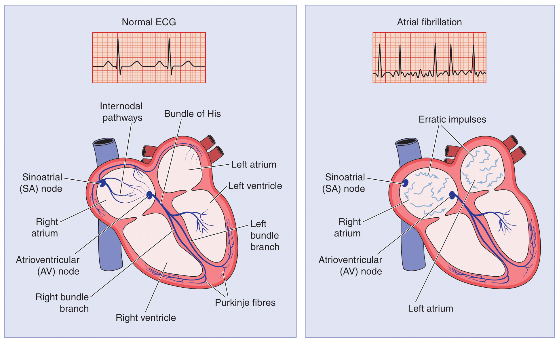 Atrial fibrillation is irregular and rapid heart rate.