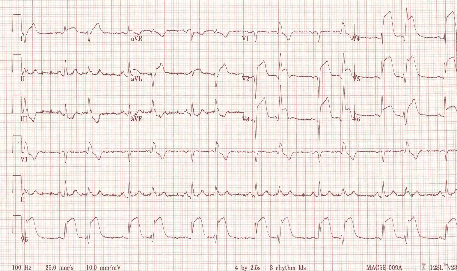Anterior wall M1 V1 ECG.