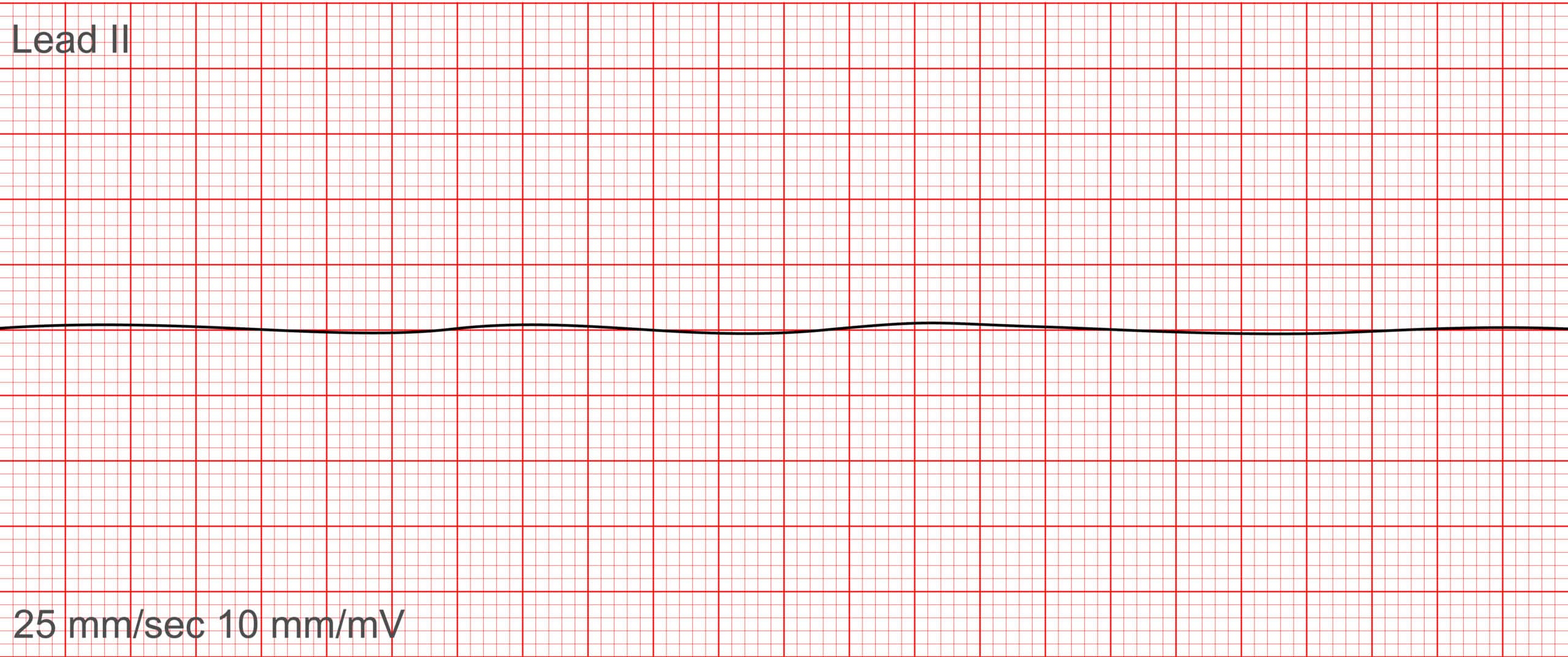 Cardiac asystole ECG.