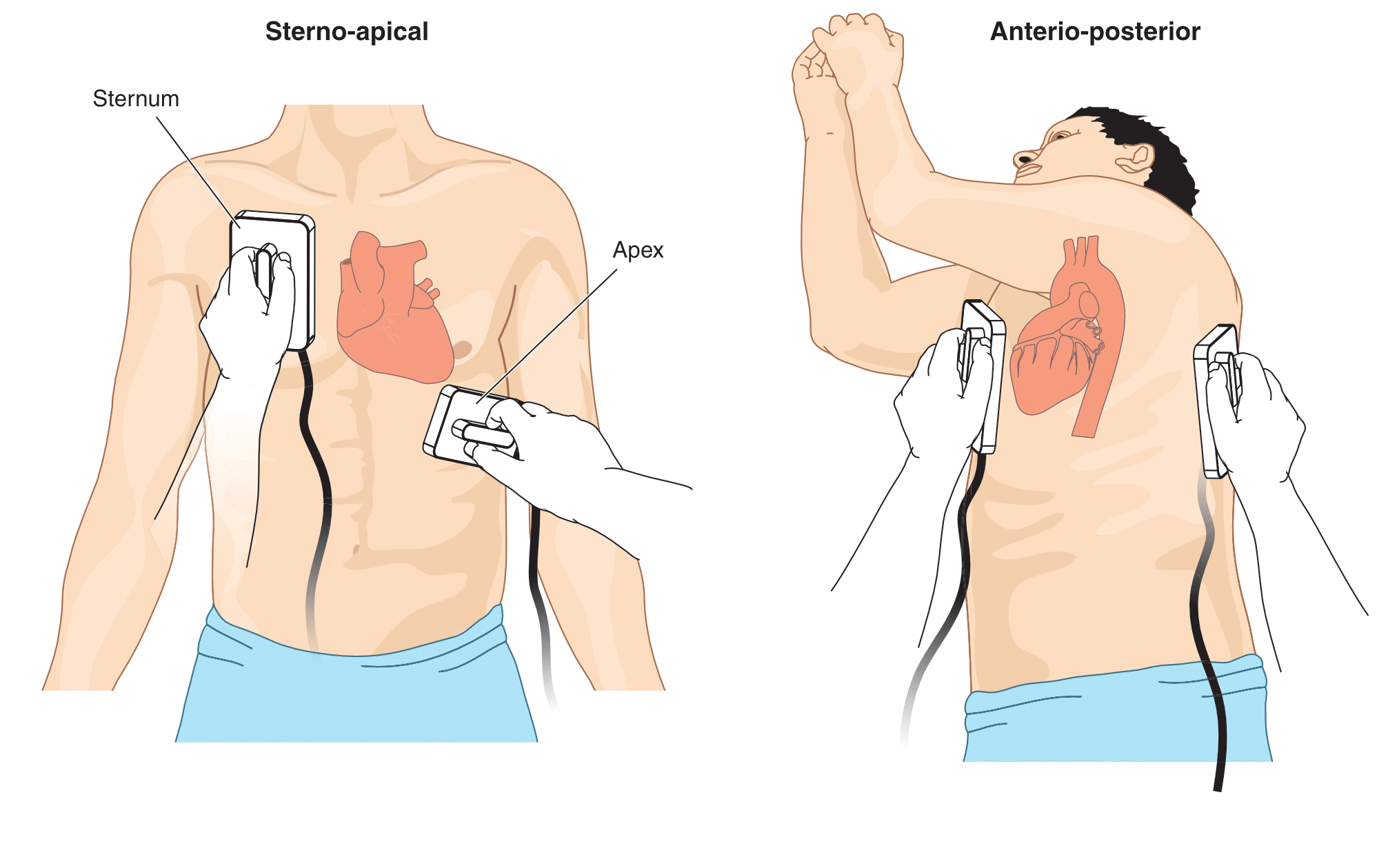 Cardioverion pad positioning.