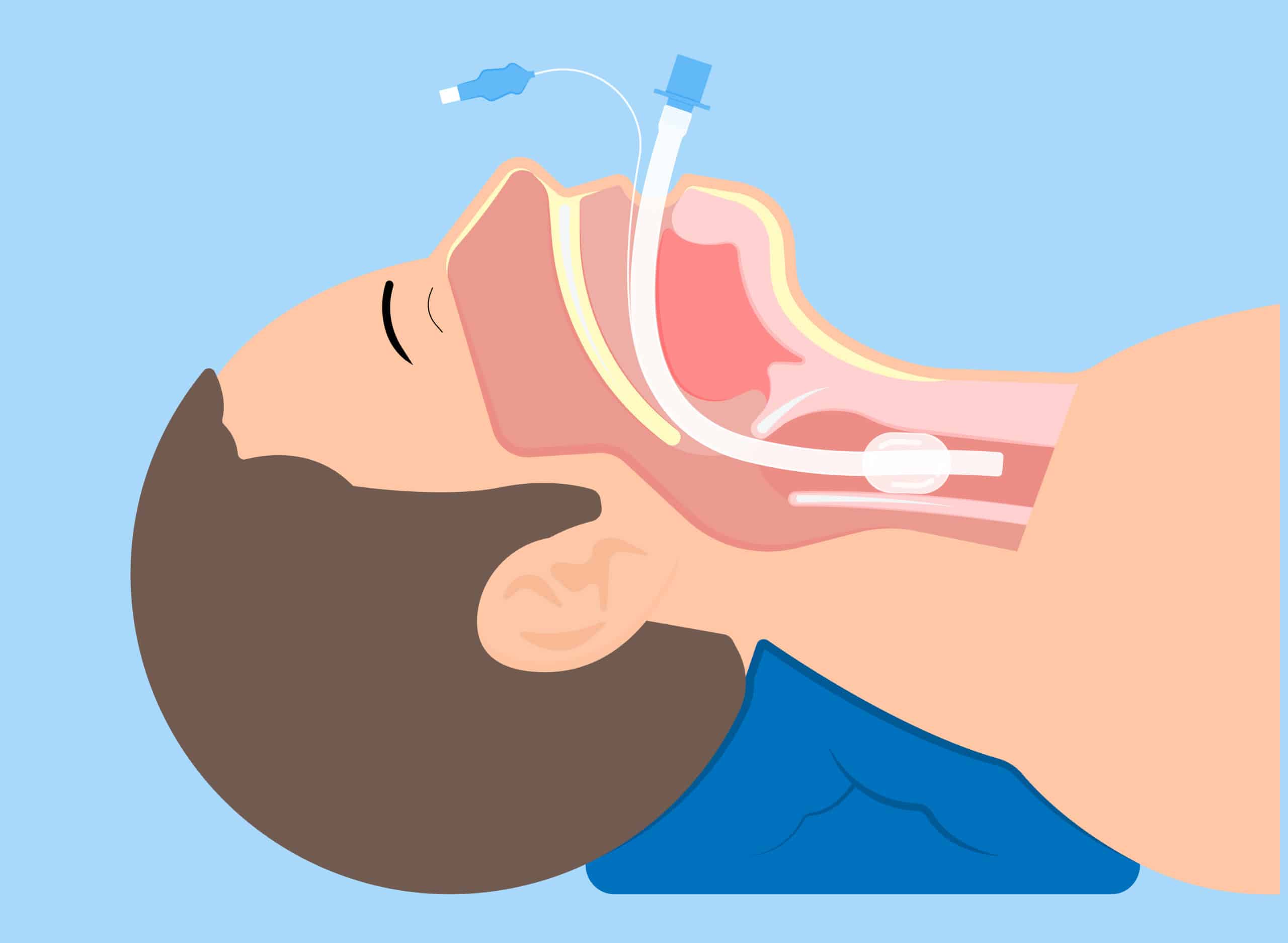 Endotracheal tube placement.