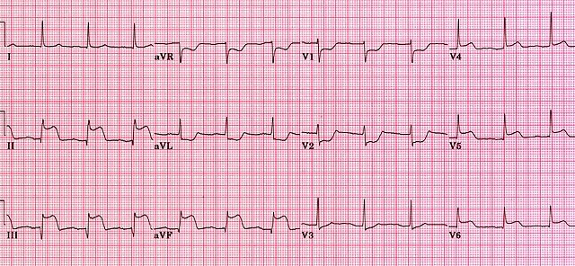 Inferior wall MI ECG.