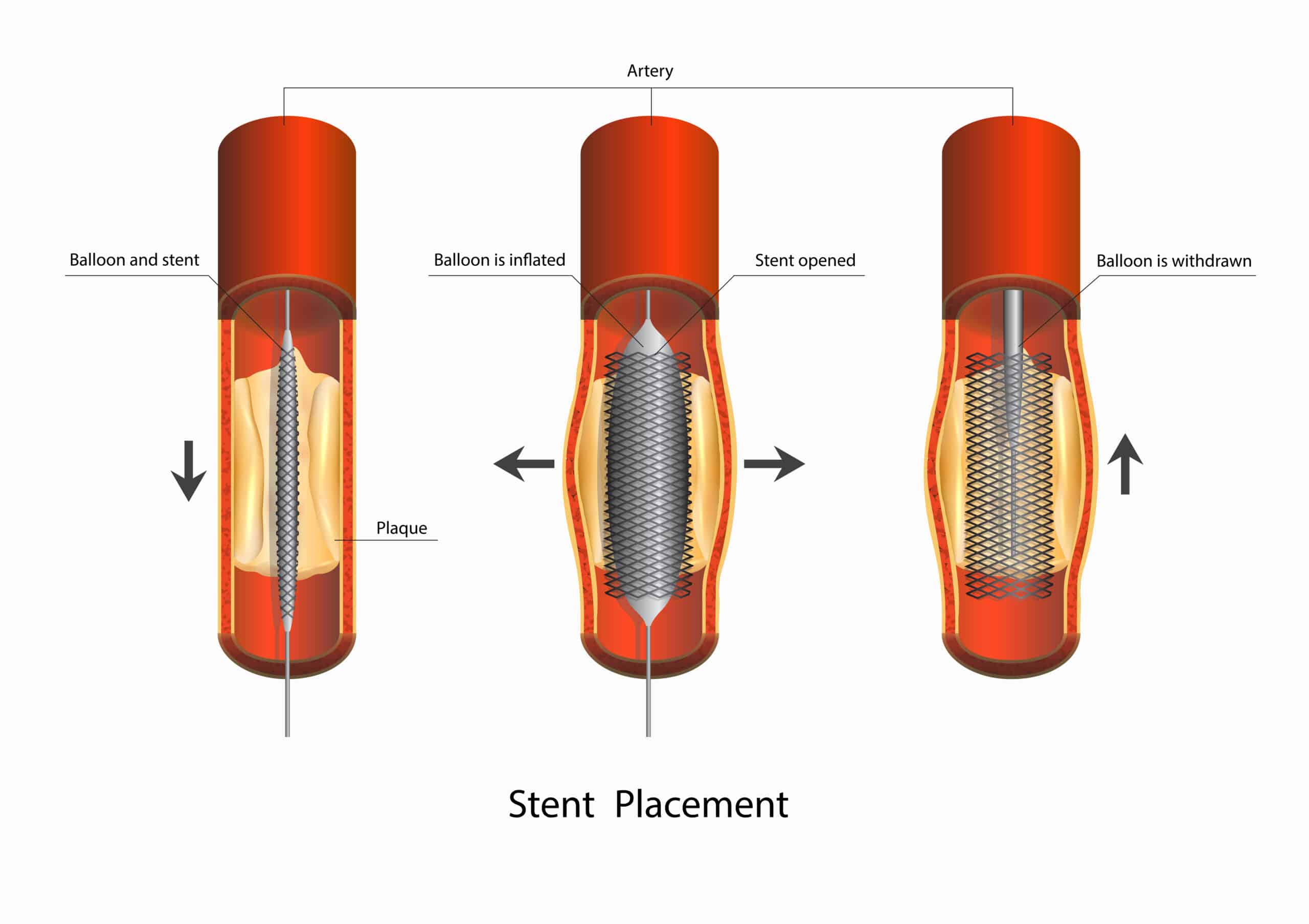 Obstructed artery stent placement.