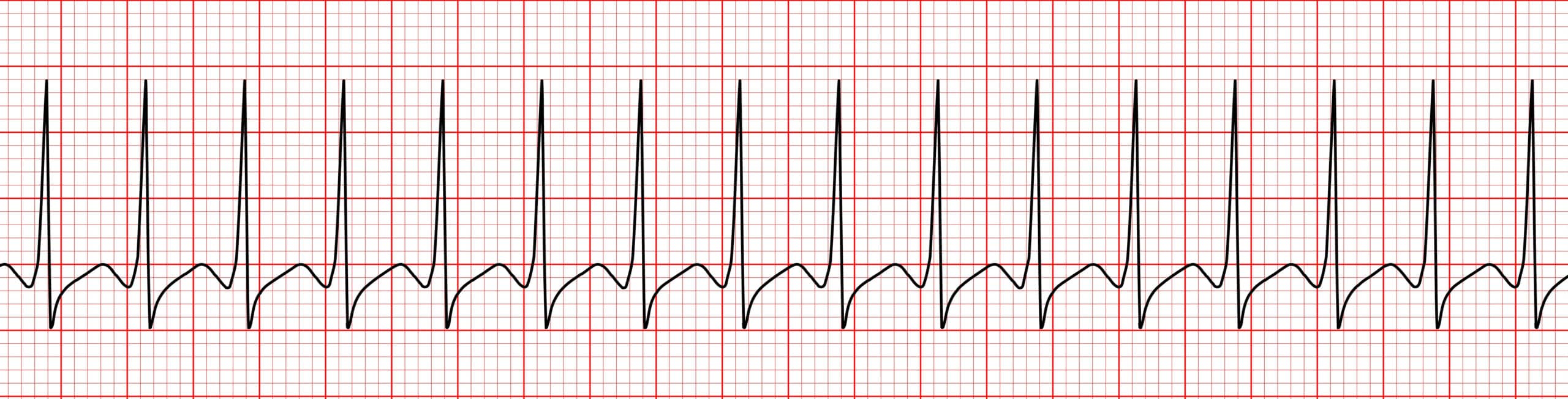 Supraventriculart tachycardia ECG.