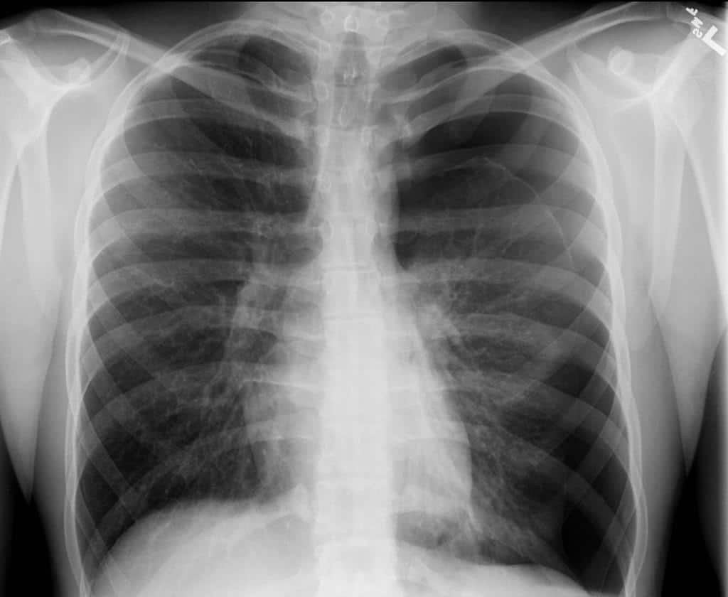 Tension pneumothorax in left lung.