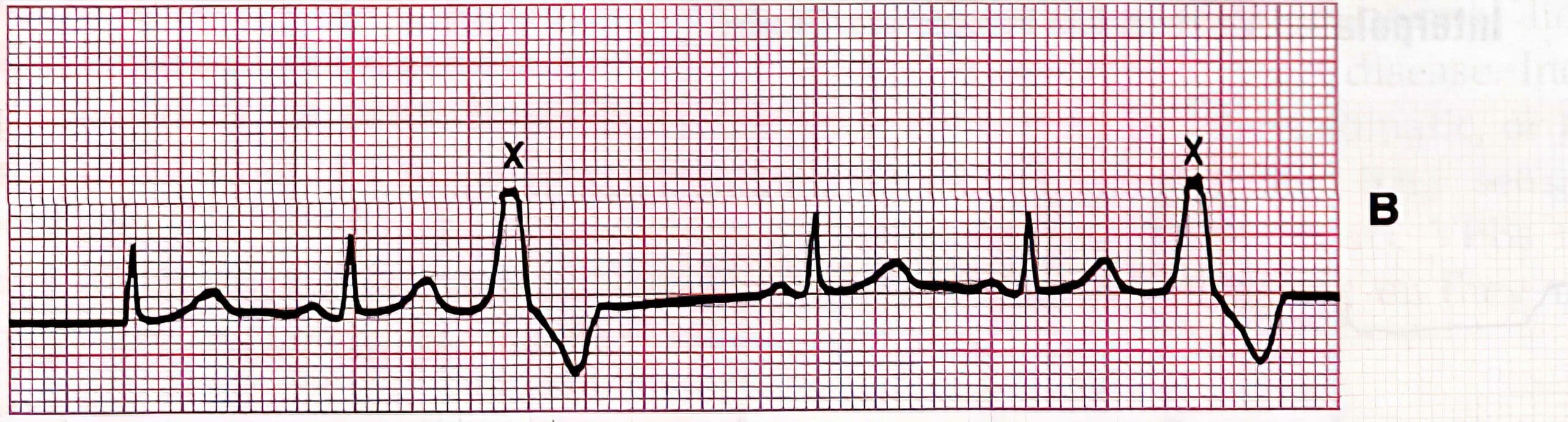 Trigeminy premature ventricular complex ECG.