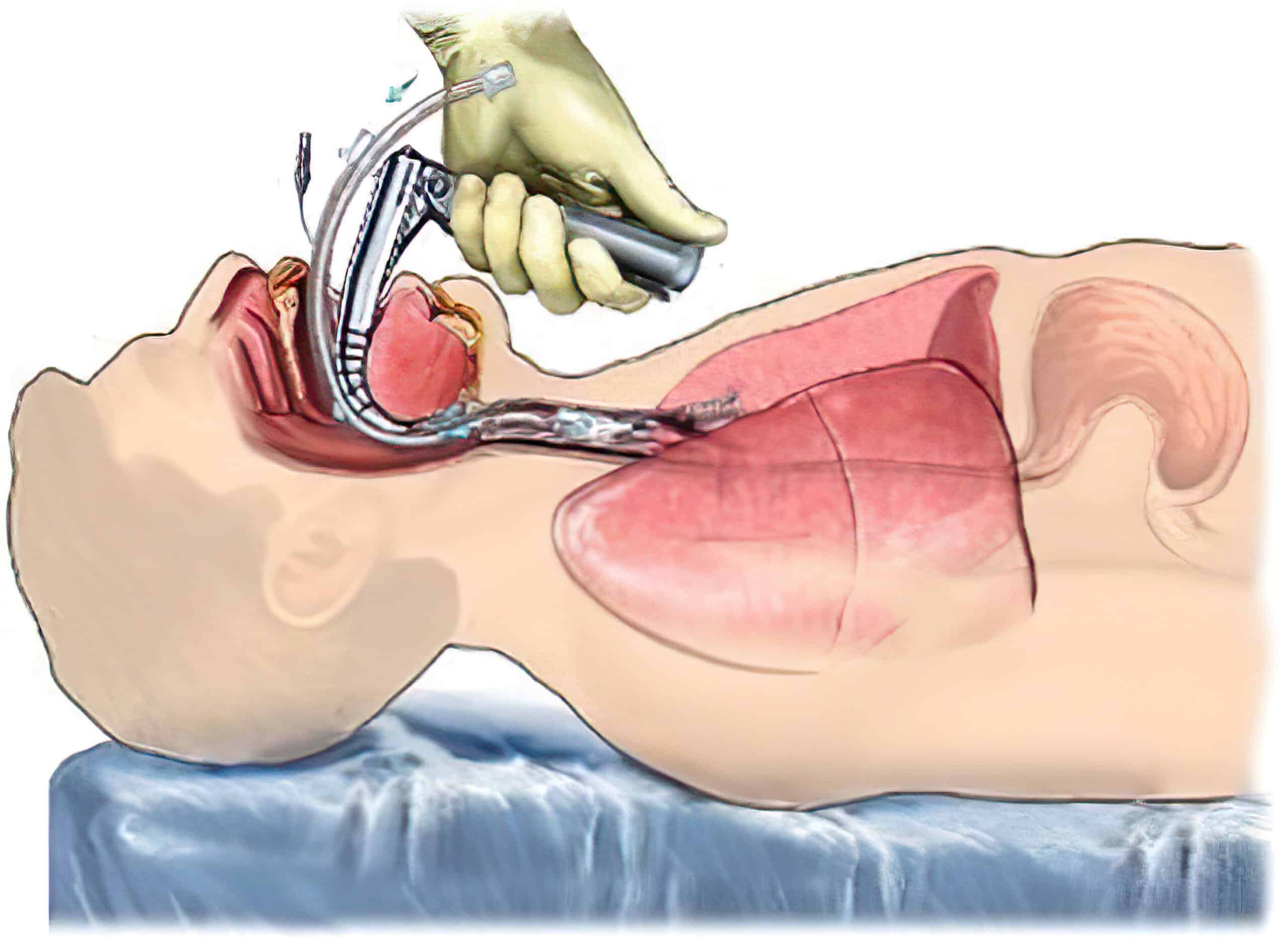 Vocal cords during ET tube placement; correct placement of ET tube.