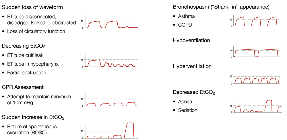 Waveform capnography: ROSC following CPR.