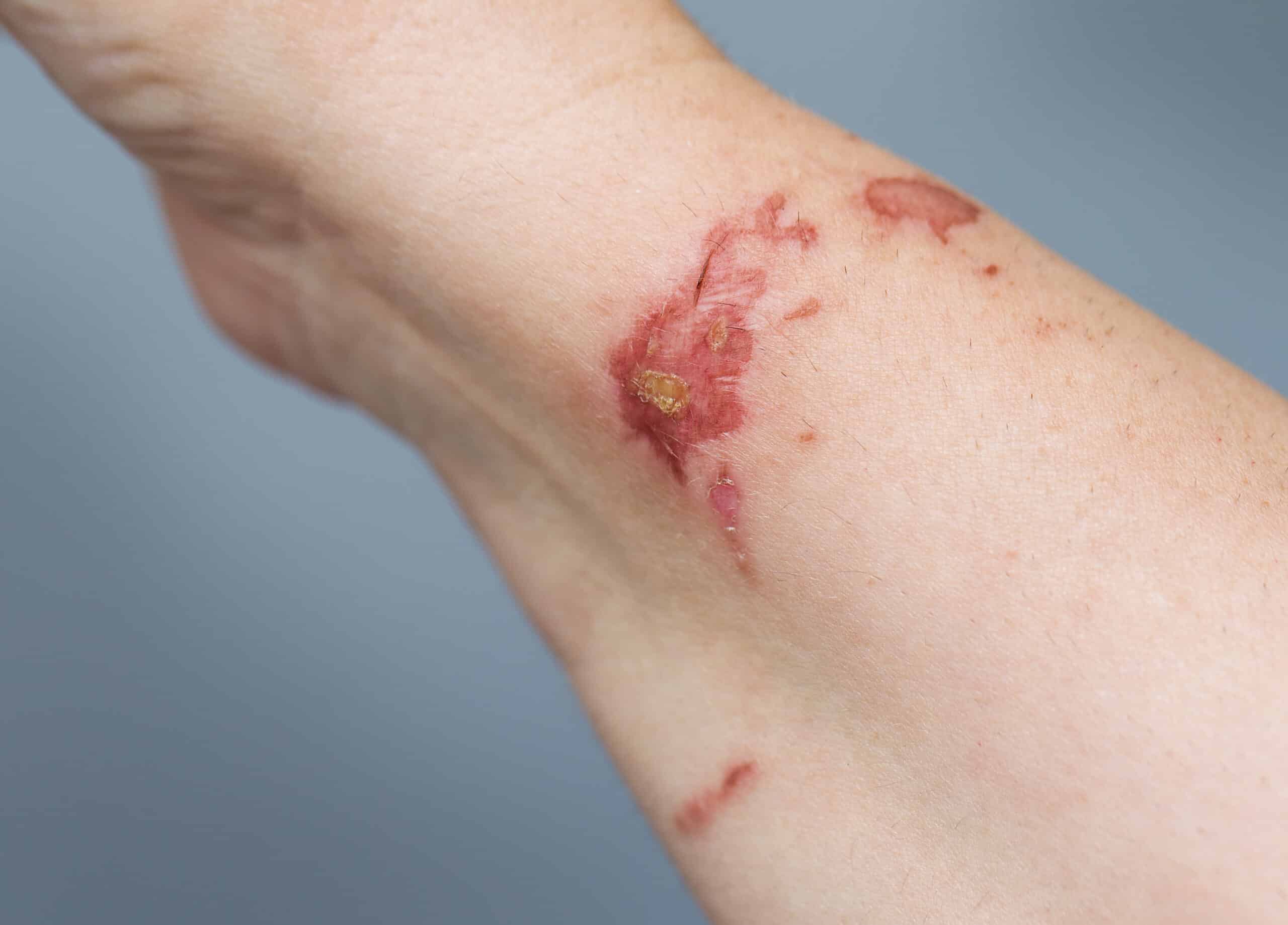 Chemical burn on person’s wrist.