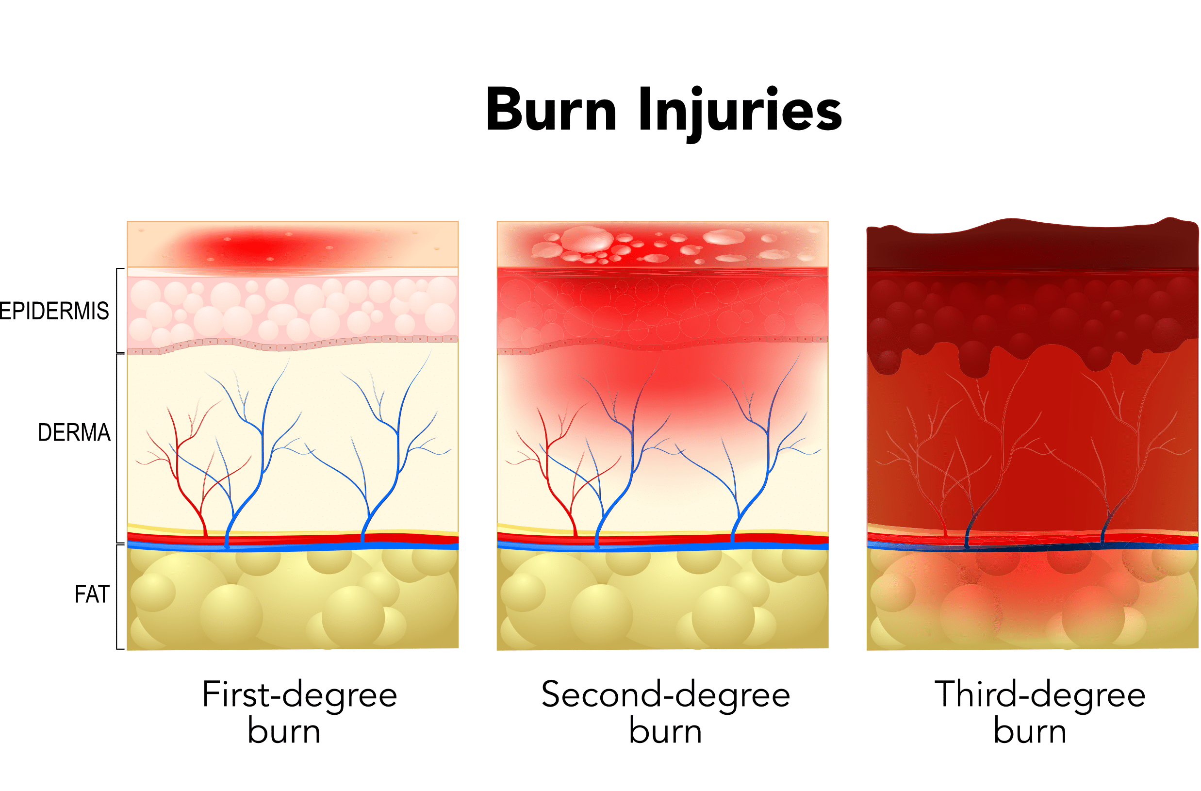Different burn degrees.