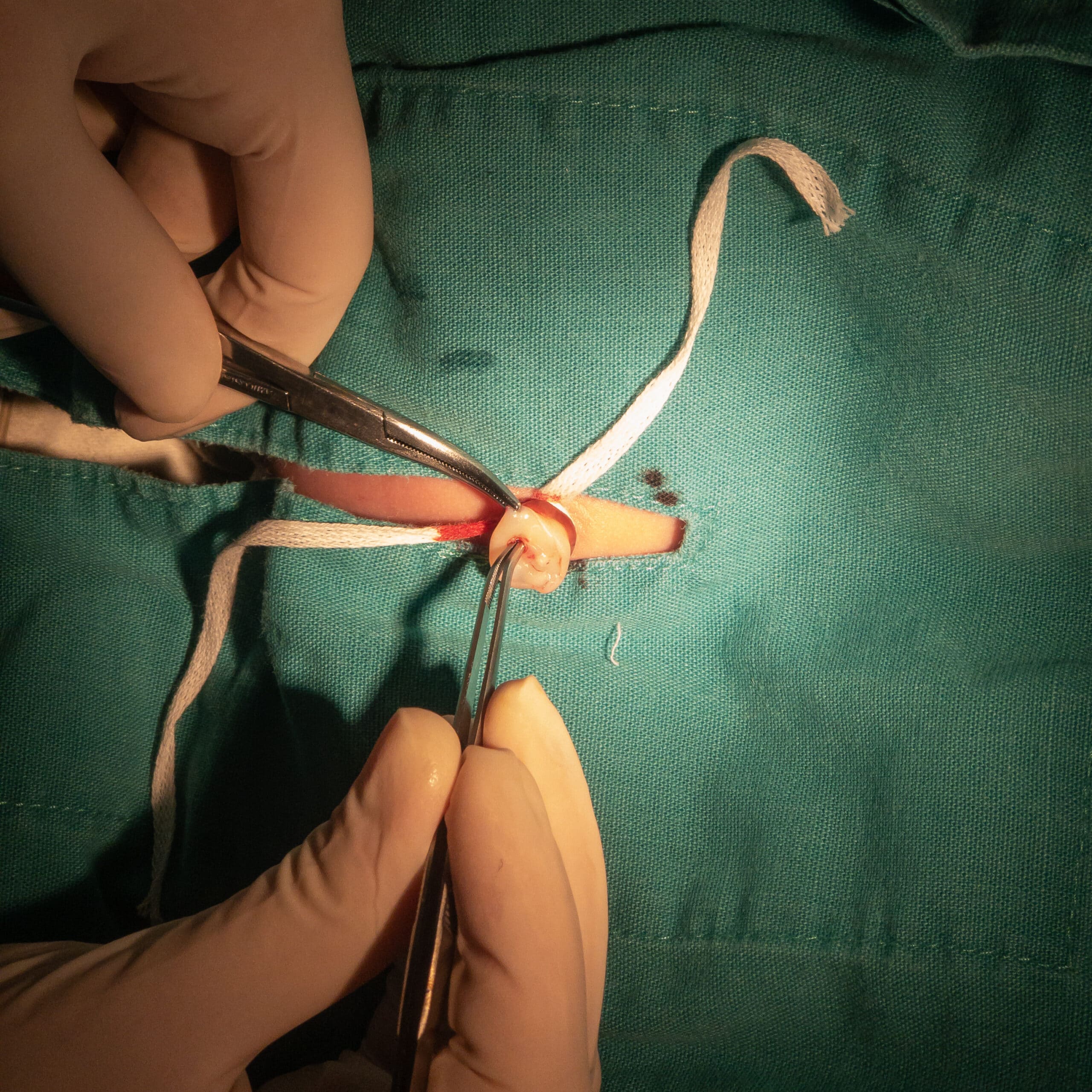 Preparing Umbilical Cord For Intravenous Catheter Placement Gloved medical clinician preparing an umbilical cord for intravenous catheter placement.
