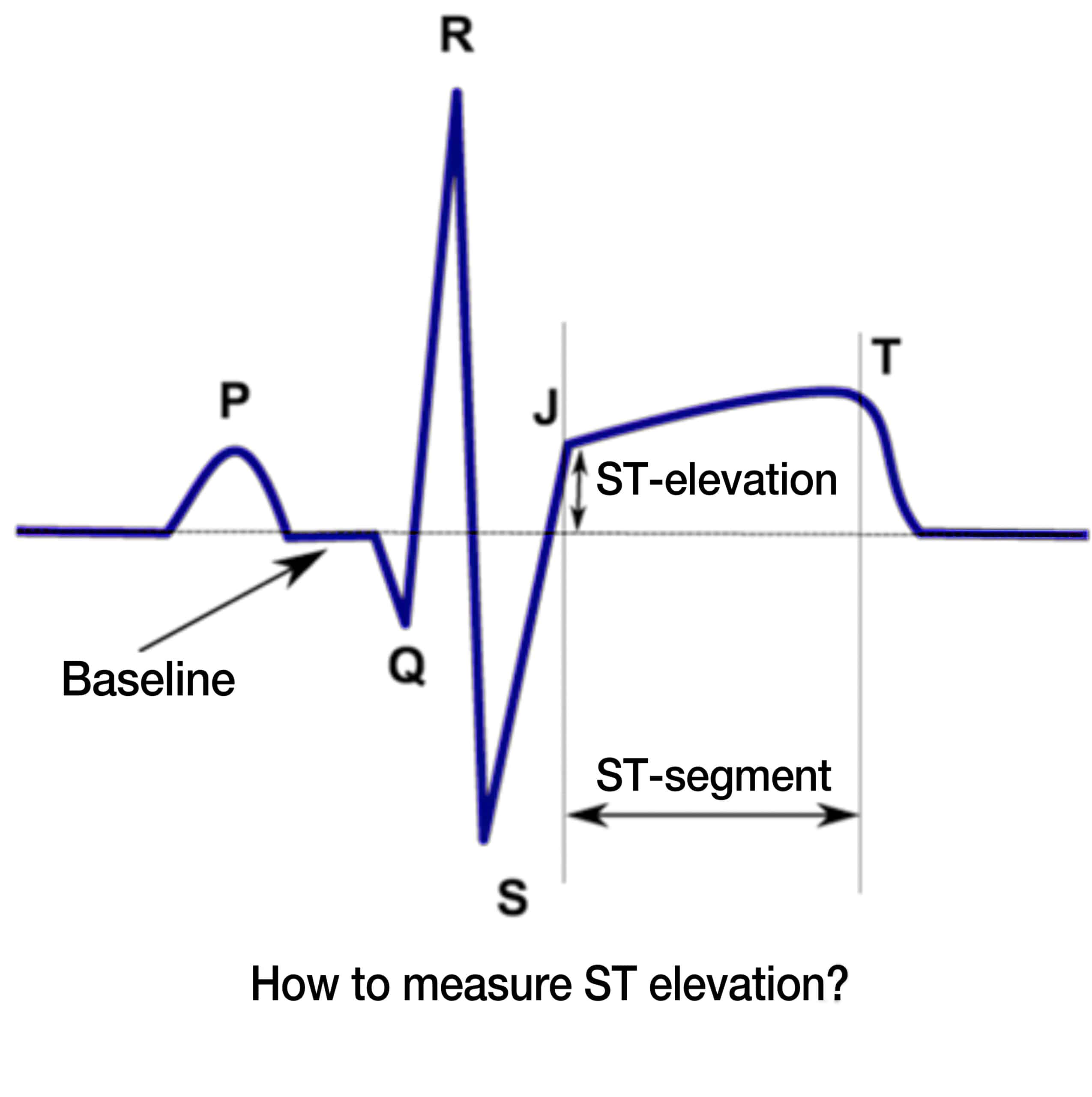 ST change measurement.