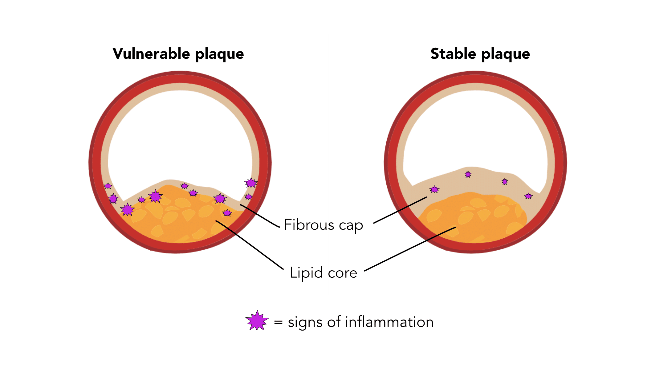 Stable versus vulnerable plaque.