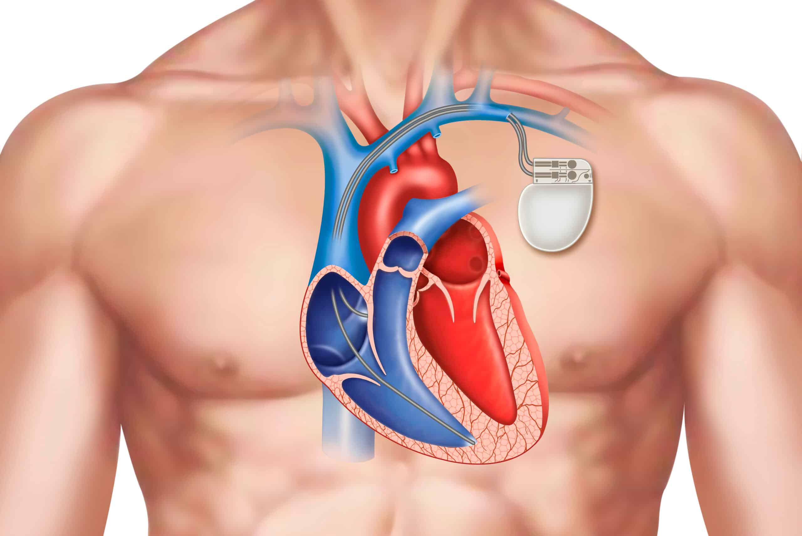Typical location of pacemaker is upper left chest or right side of chest or abdomen.