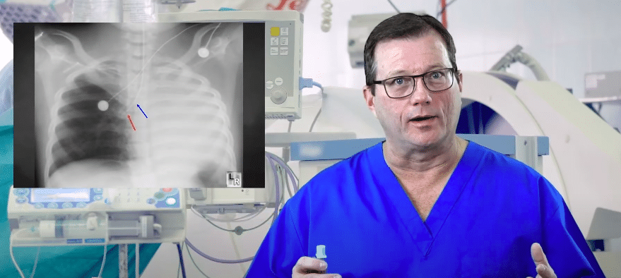Fixing Right Mainstem Intubation