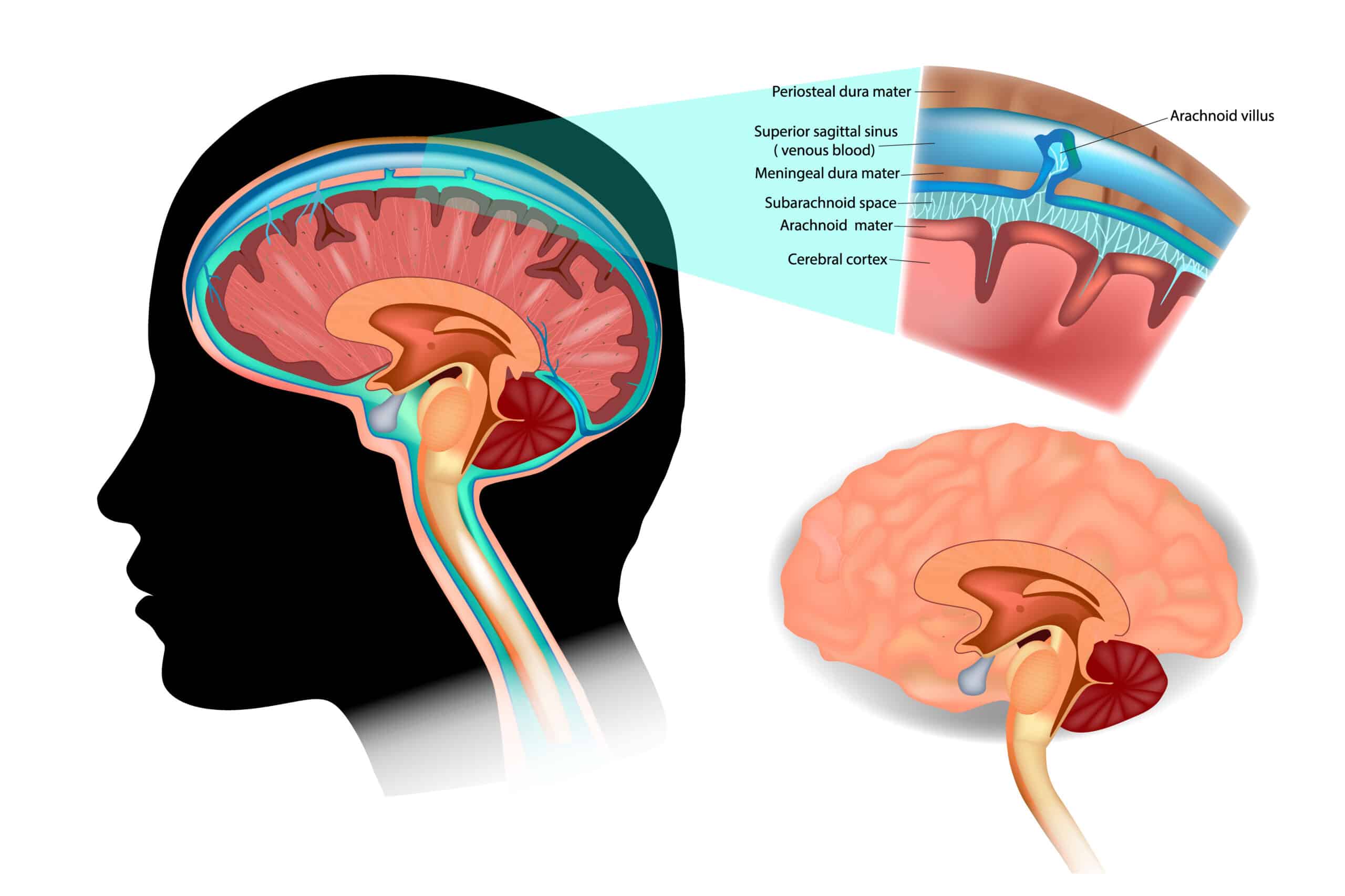 Respiratory acidosis can eventually lead to increased intracranial pressure.