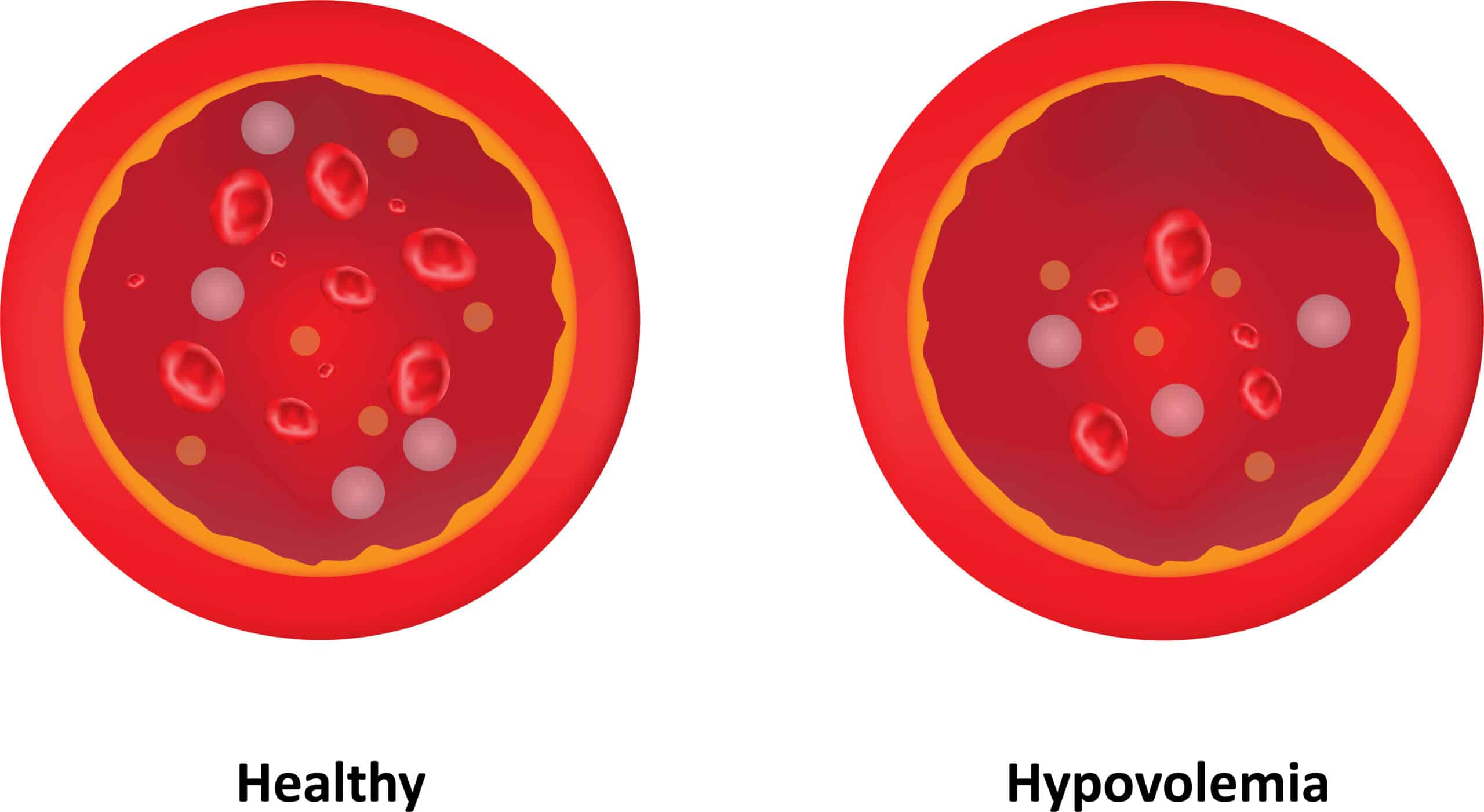 Comparison of blood volume between healthy circulation and hypovolemia.