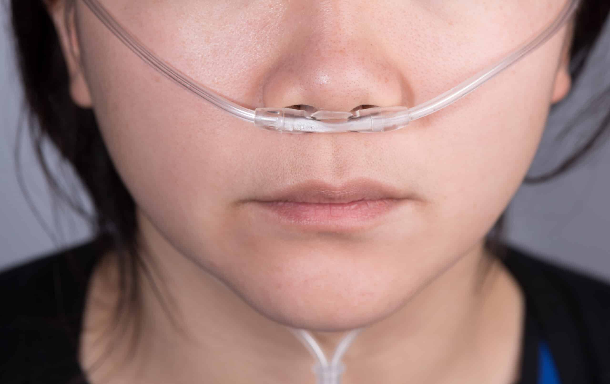 Nasal cannula placement in nostrils.