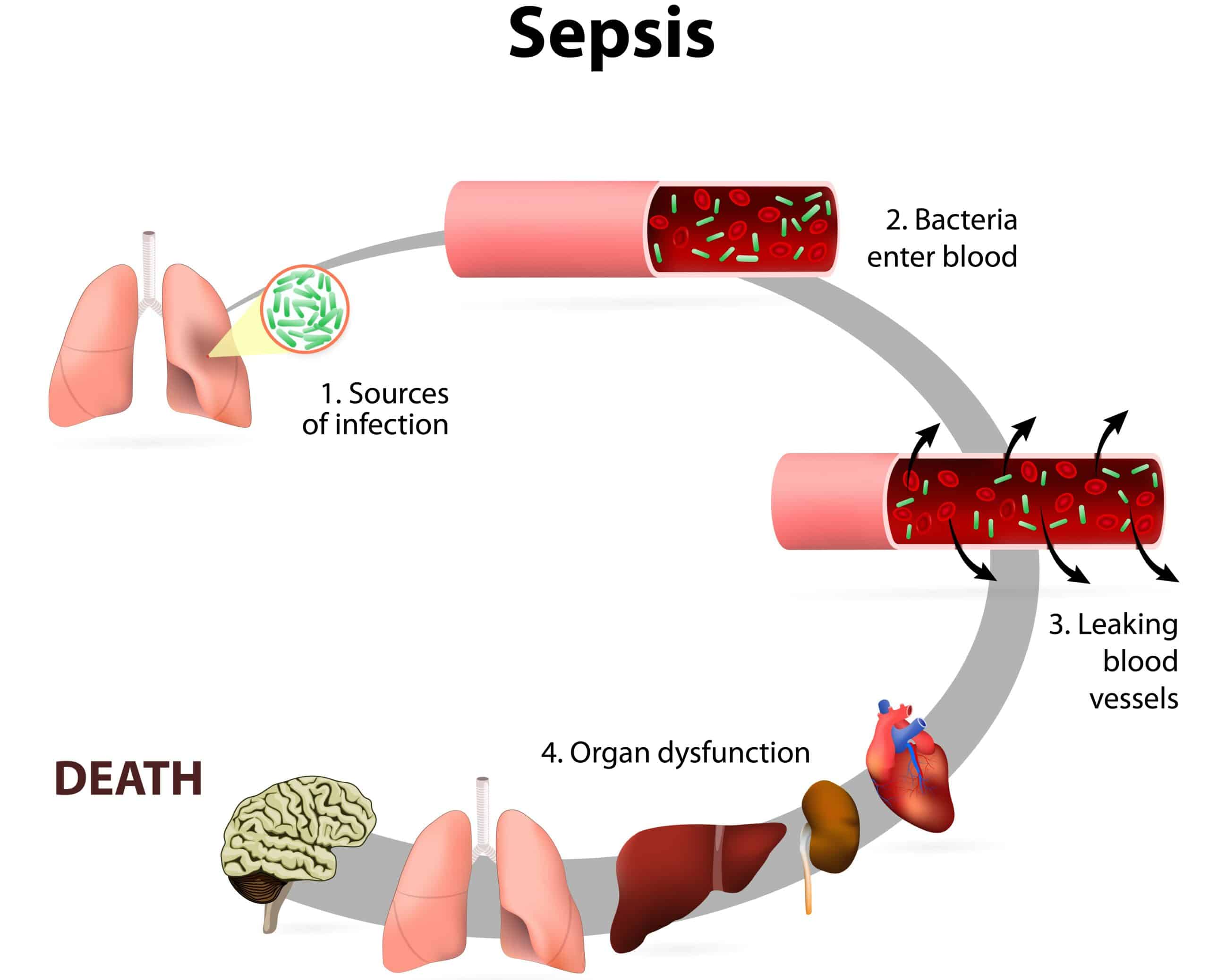 Sepsis - diagram of the process.