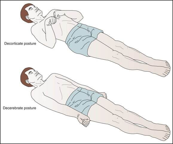 Types of motor responses - Glasgow Coma Scale.