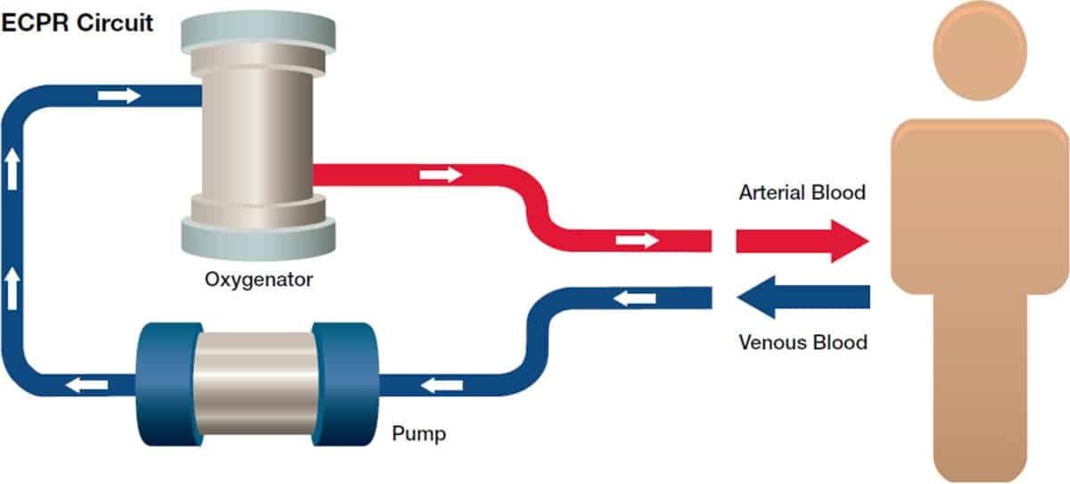 ECPR circuit diagram.