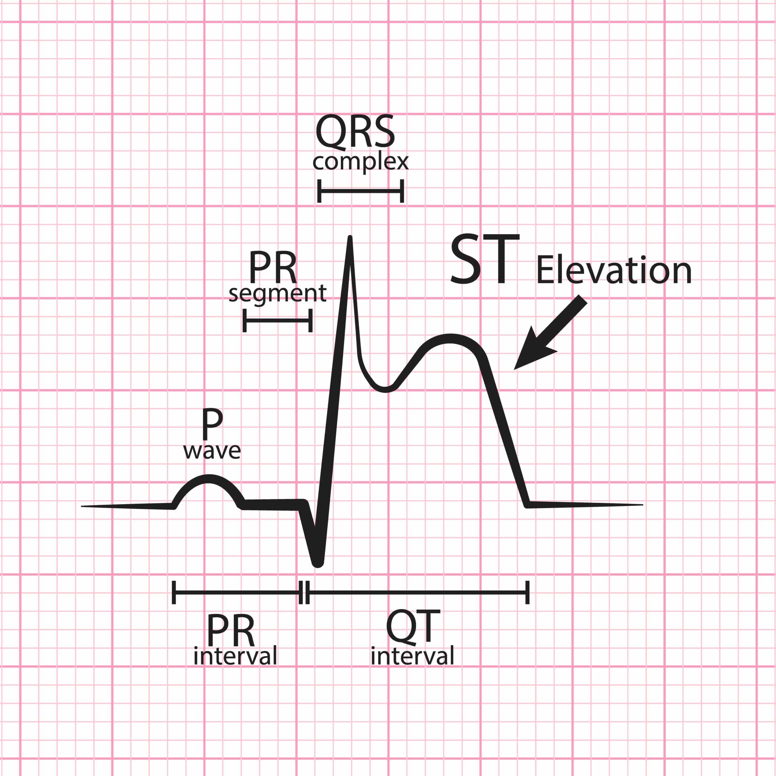 ACS and STEMI Systems of Care