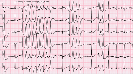 ECG tracing of Torsades de Pointes, a type of polymorphic ventricular tachycardia.