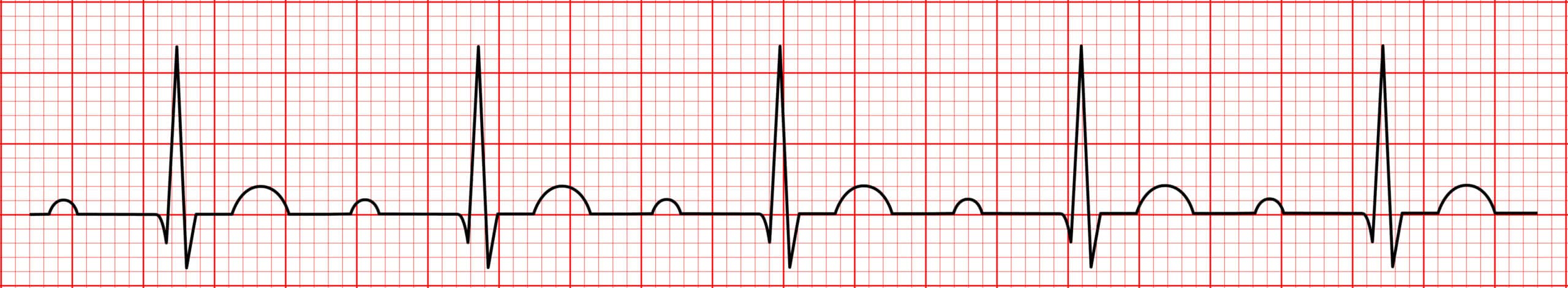 1st-degree AV block ECG.