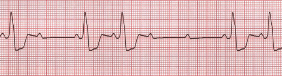 2nd degree AV block Mobitz type II ECG.
