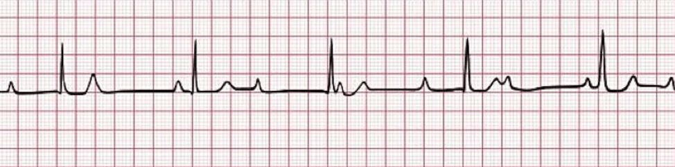 3rd-degree AV Block ECG.
