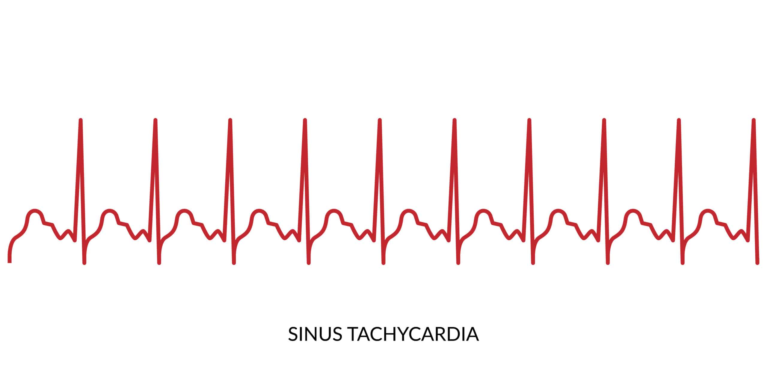 Some causes of tachycardia are tachyarrhythmia and physiologic stress.