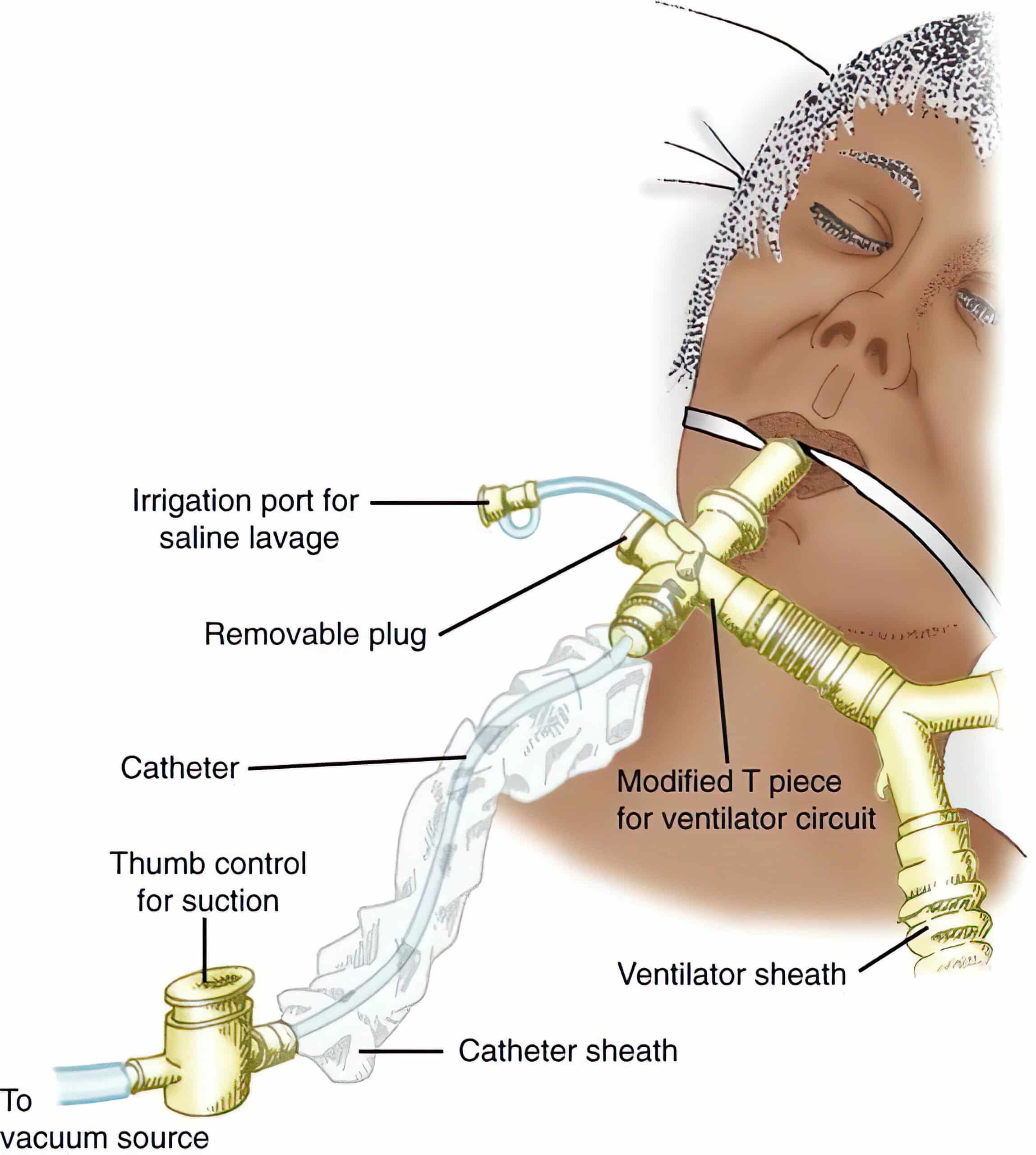 Closed suction device.