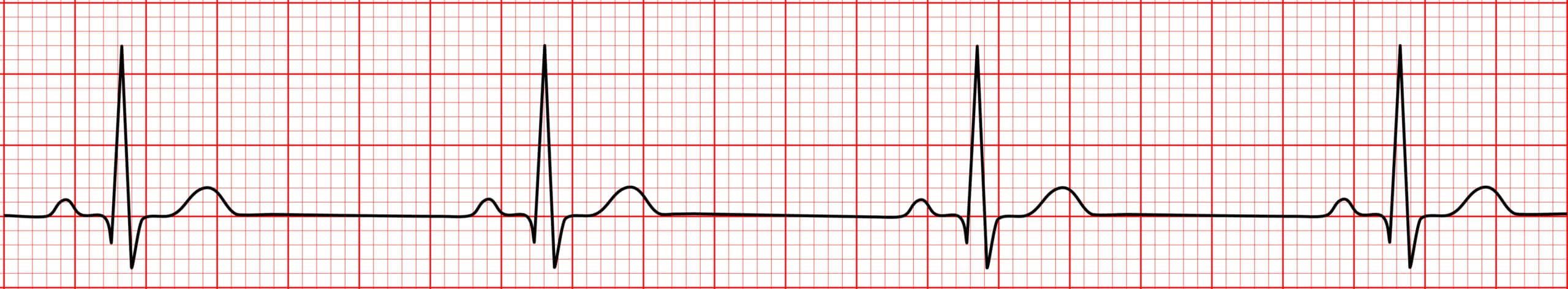 ECG strip displays sinus bradycardia.