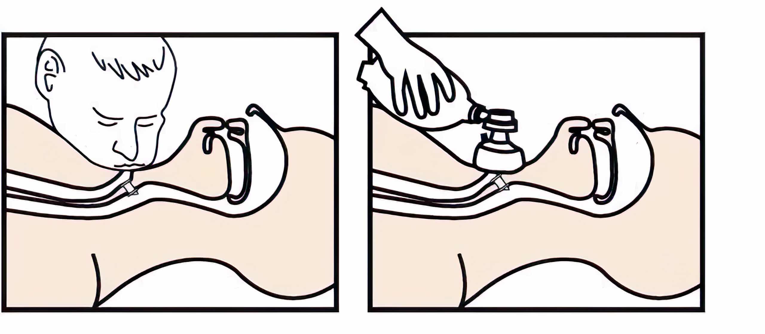Mouth/bag-to-stoma.