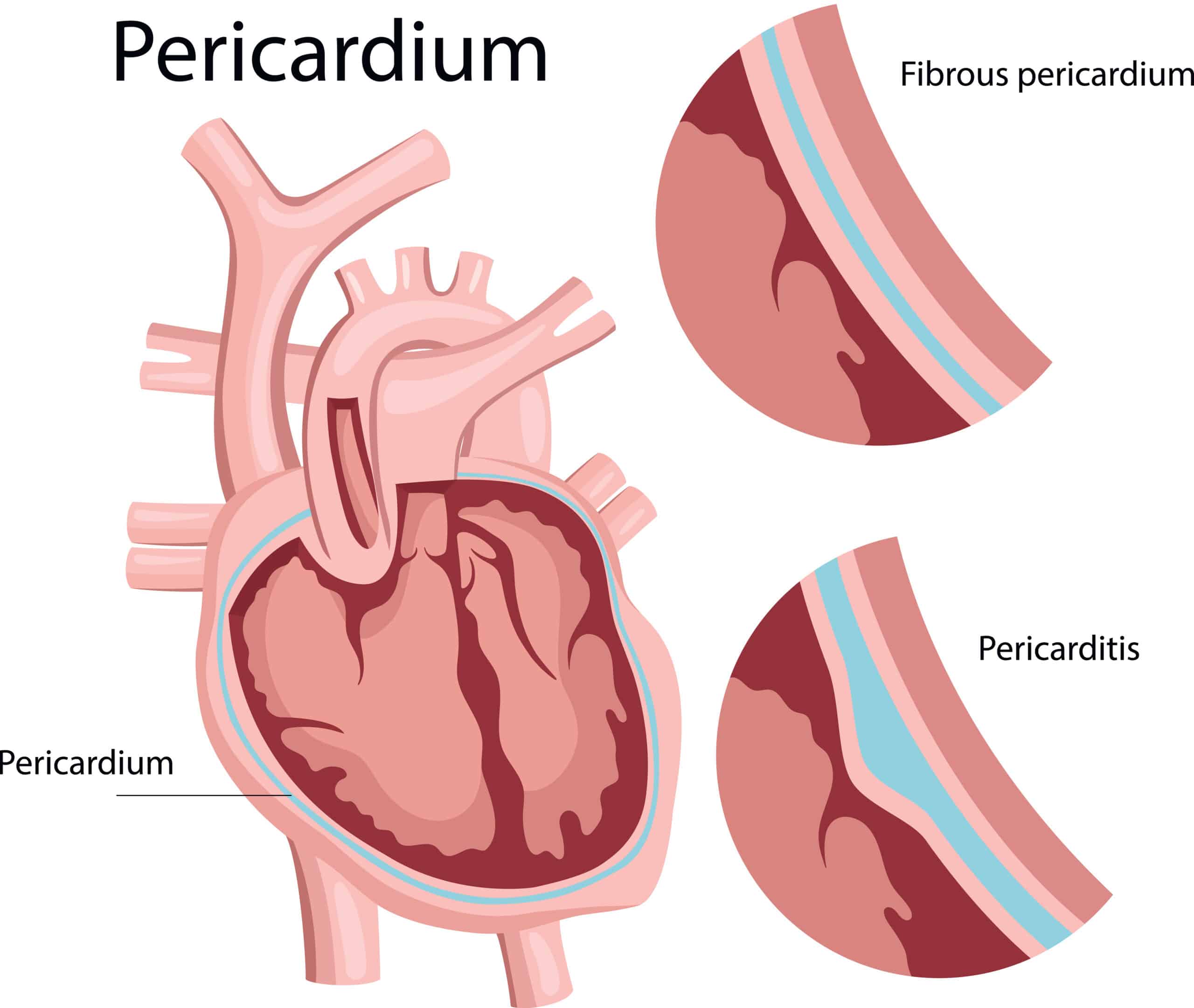 Pericardium sac surrounds heart.