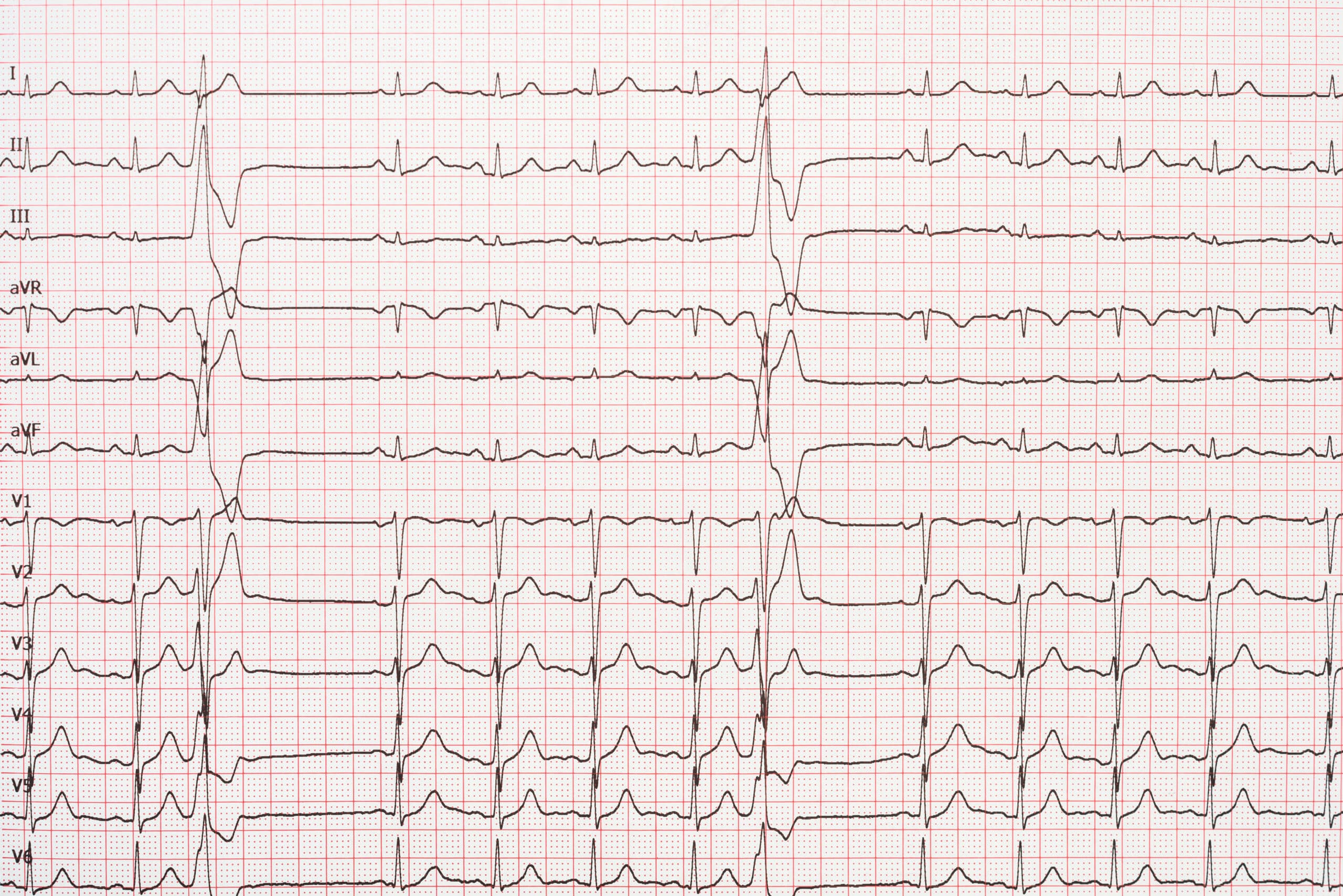 12-lead ECG tracing.