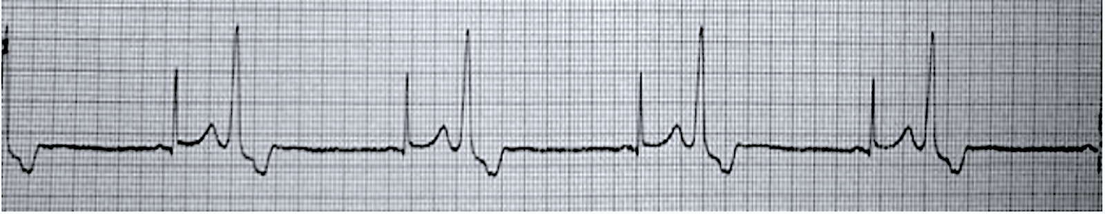 Bigeminy ECG Tracing Bigeminy - ECG tracing.