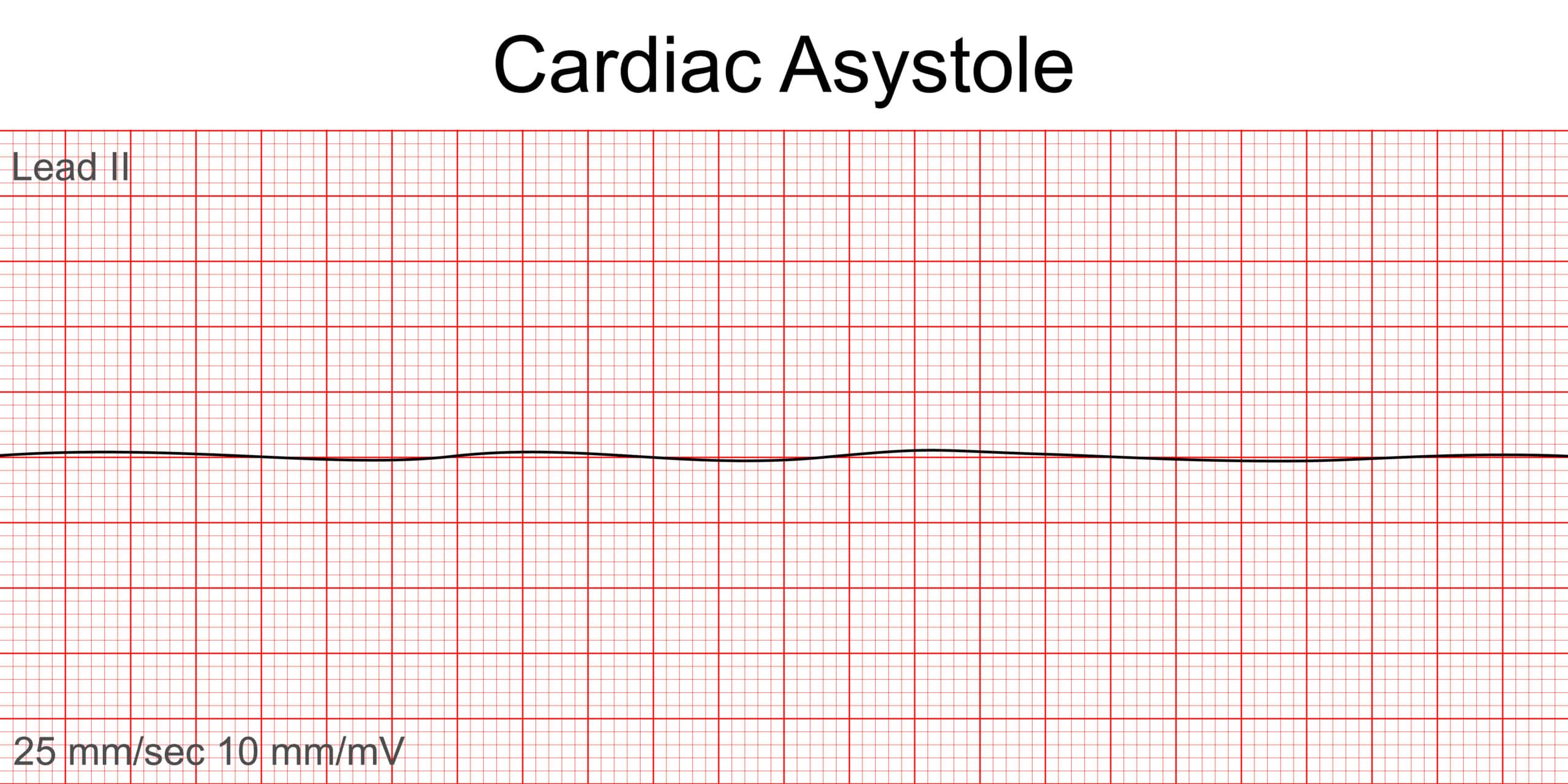 Cardiac asystole on ECG tracing.