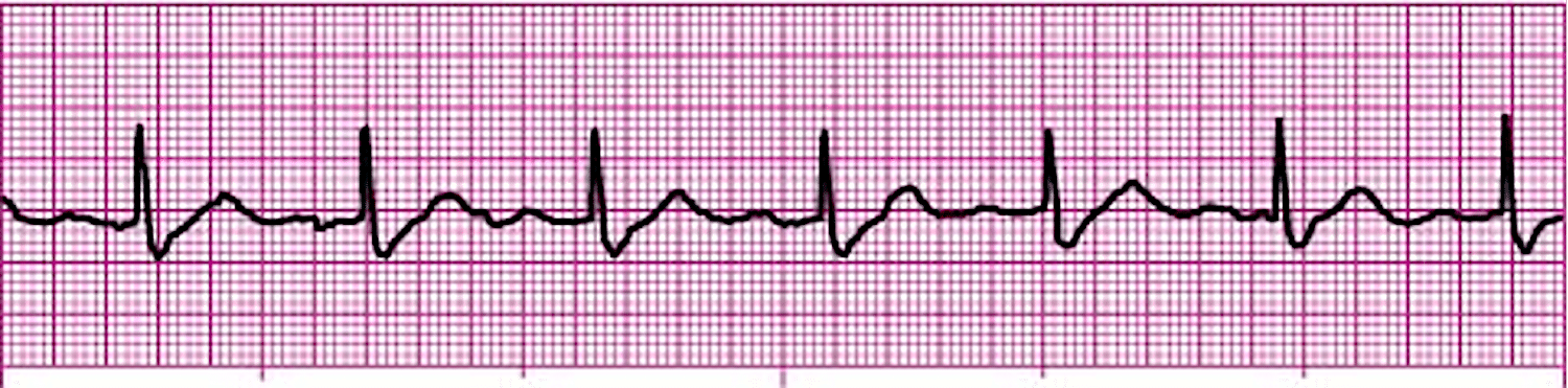 First-Degree Atrioventricular Block on ECG First-degree atrioventricular block on an ECG tracing.