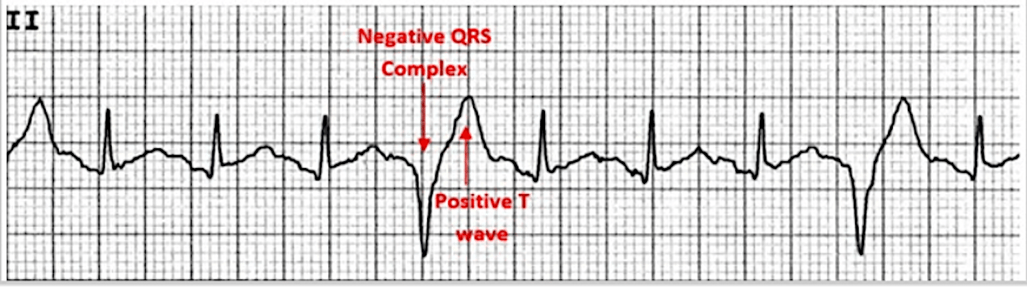 PVC ECG Tracing Premature ventricular complex (PVC) - ECG tracing.