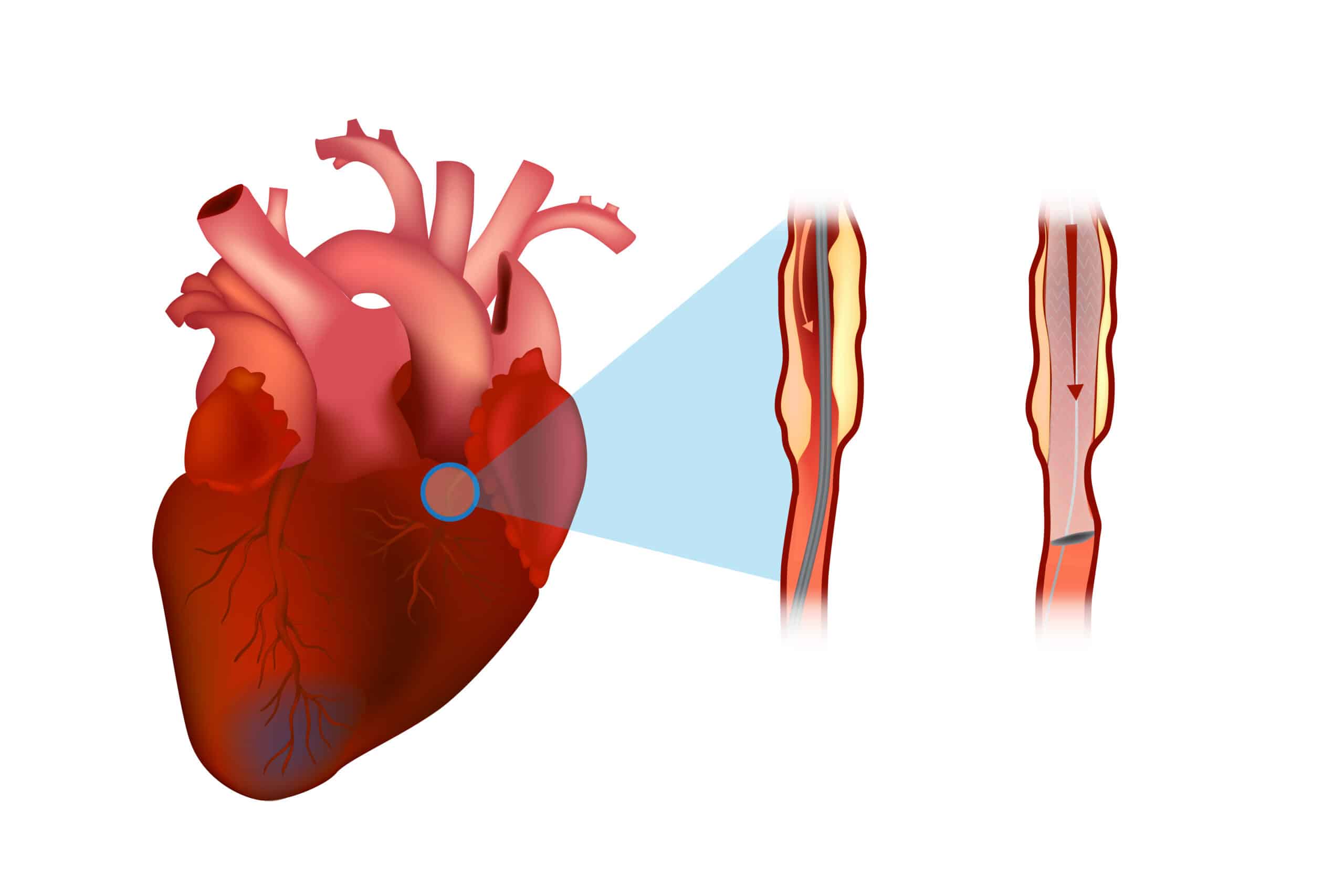 A stent placed in a coronary artery to reperfuse the heart