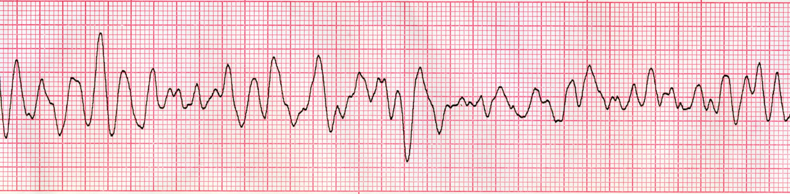 VF ECG Tracing Ventricular fibrillation – ECG tracing.