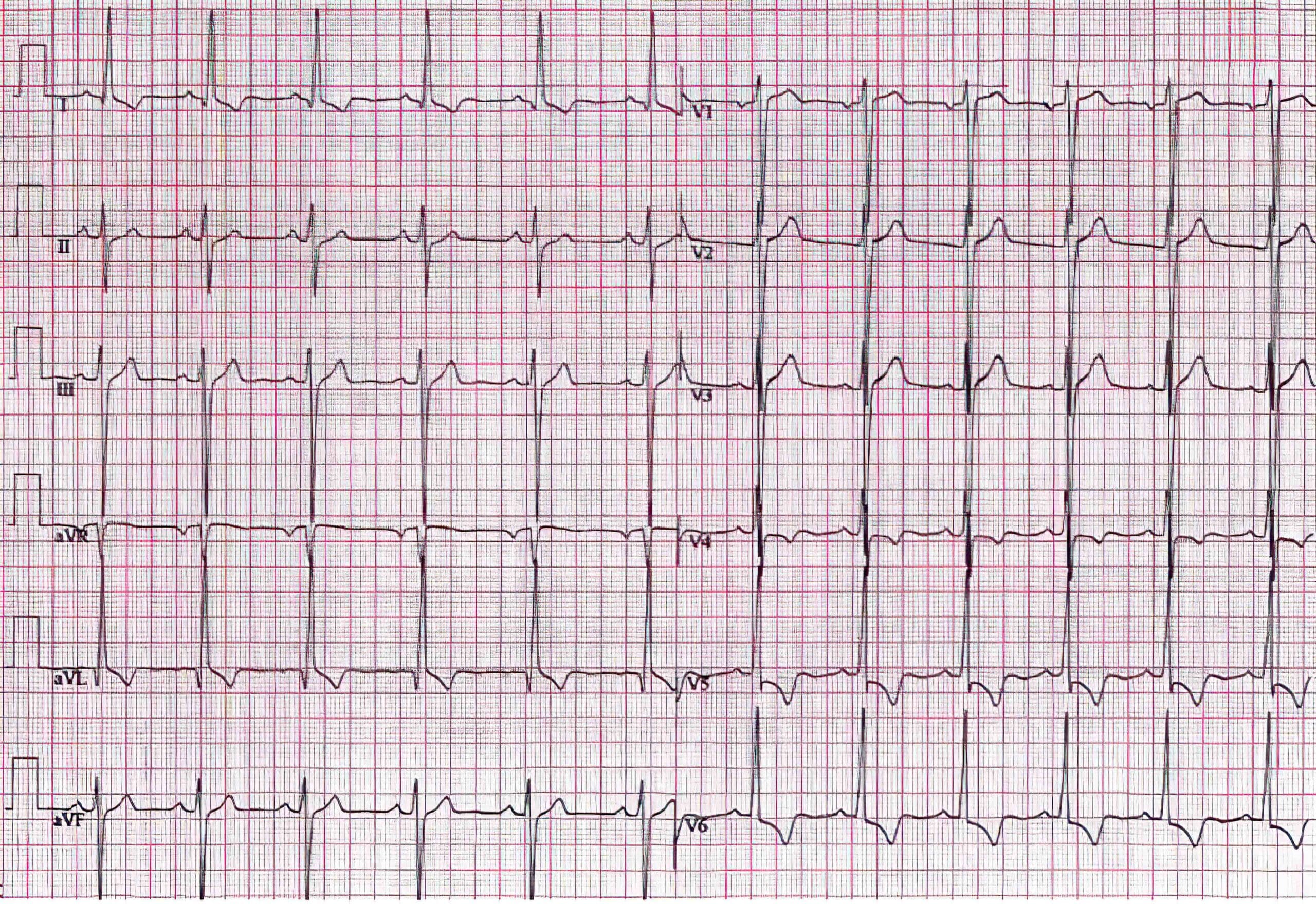 12-lead ECG of 52-year-old man with severe LVH 1 year after aortic valve replacement.