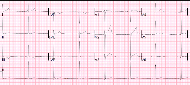 20-year-old man with lightheadedness ECG after exercise.