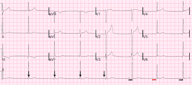 20-year-old man with lightheadedness ECG.